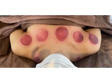 リベル(Liber)/人気のリンパ＋カッピングセット