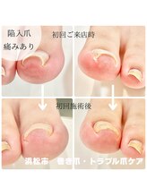 ラフィング(Laughing)/巻き爪矯正