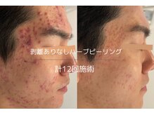 ライフサロン 別府(Life Salon)/お顔ハーブピーリング4