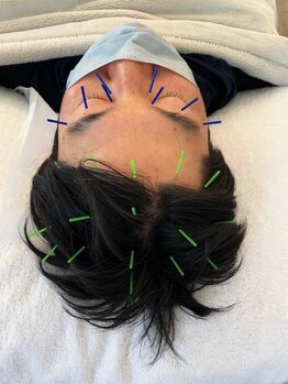 コス(KOS)/頭鍼(眼精疲労アプローチ)