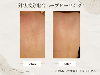 プライベートエステサロン トゥインクル/背中のサメ肌でお悩みの方にも◎