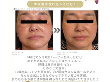 アイル そよら海老江店/ホワイトスノーピール結果