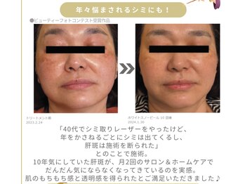 アイル そよら海老江店/ホワイトスノーピール結果