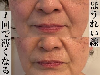 ビジュープラス 広島店(Bijou+)/【60代/たるみ】