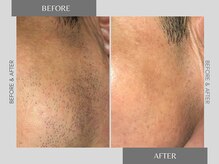 テリー(Terry)/メンズ　ヒゲ脱毛　before after