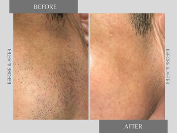 テリー(Terry)/メンズ ヒゲ脱毛 before after