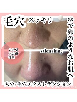サロンシャイン(Salon Shine)/毛穴エクストラクションプロ