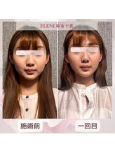 エレーニ 麻布十番(ELENI)/18歳の方からの感想【小顔矯正】
