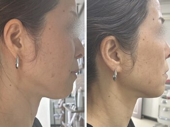 ピュアリー(purly)/【レモンボトル】Before After