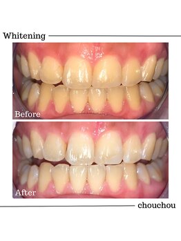 シュシュ(chouchou)/歯のセルフホワイトニング比較
