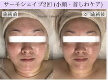 ラエッセ(La Esse)/小顔&首のシワケア！効果実感☆