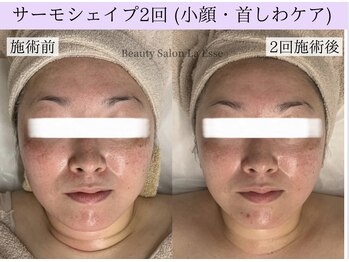 ラエッセ(La Esse)/小顔&首のシワケア!効果実感☆