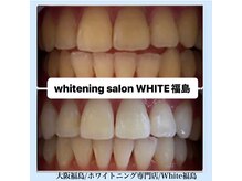 ホワイトニングサロン ホワイト(WHITE)/セルフホワイトニング/大阪/福島