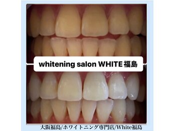 ホワイトニングサロン ホワイト(WHITE)/セルフホワイトニング/大阪/福島