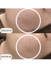 プリドー(PULIDO)/エピダーマルスキン