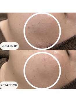 プリドー(PULIDO)/エピダーマルスキン