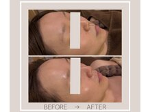 ミルトゥ(myrte)/Before→After