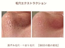 ミリ(MiLi)/毛穴エクストラクション