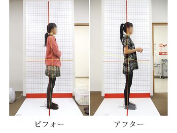 ほねつぎ 平成けやき通り鍼灸接骨院/骨盤矯正ビフォーアフター1