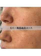 アール アンド ビューティーサロン(Ｒ＆ BeautySalon)/頬の毛穴たるみ改善