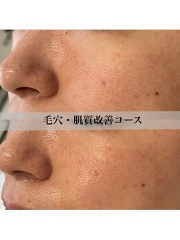 アール アンド ビューティーサロン(Ｒ＆ BeautySalon)/頬の毛穴たるみ改善