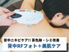 【背中シミケア◎ニキビケア】背中RFフォト＋美肌水素ケア付き