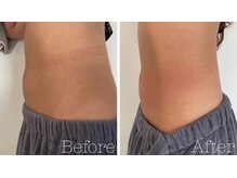 トゥモロー(TOMORROW)/下腹スッキリ