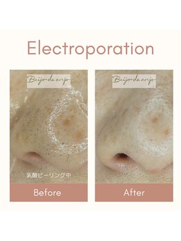 ベイジョ デ アンジョ(Beijo de anjo)/毛穴の黒ずみ除去