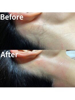 ルミナ シブヤ(LUMINA SHIBUYA)/【女性】脱毛