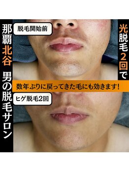 ディースタイル 北谷店(Dstyle)/北谷メンズ脱毛ヒゲBefore after