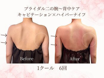 エステティックサロン アールグレー/ブライダルエステ1ヶ月6回の変化