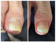 フレッシュフット(FreshFoot)/足のトラブルお任せください