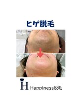 ハピネス 広島並木通り店(Happiness)/ヒゲ脱毛