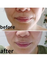 心音/ふっくらして浅いほうれい線に。