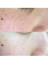 ミーミー 多治見店(MeMe.)/毛穴エクストラクション