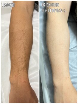 ルシャトン(Le Chaton)/うで脱毛