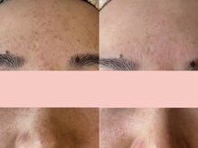 ユーヘン(uhem)/【PICO】幹細胞上清液施術症例