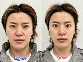 アモーラ(Amora)/エクソソーム導入