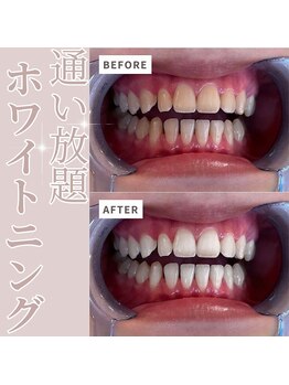 エクシアホワイトニング 六本木店/ホワイトニングビフォーアフター