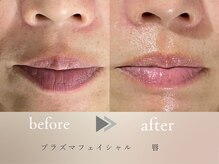 グロッシー(glossy)/【症例】唇・首も含め全顔のケア