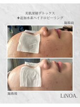 LiNOA./深層デトックス×追加水素洗浄