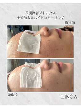 LiNOA./深層デトックス×追加水素洗浄