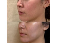 リフテグレース(LIFTE Grace)の雰囲気（光フェイシャル３回目でここまで変化をだせるハイスペック）