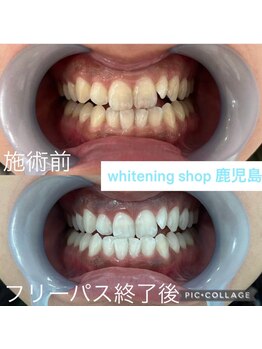 ホワイトニングショップ 鹿児島店/#鹿児島ホワイトニング