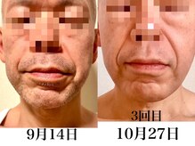 悠/メンズ☆LEDヒゲ脱毛