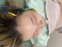 もみの木鍼灸整骨院 恵比寿/顔回りスッキリ！美容鍼＆首回り