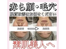 ホリシア 博多(HORISHIA)/ハーブピーリング/ニキビケア