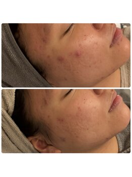 ブルー(blue.)/剥離ありハードハーブピーリング