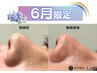 【6月限定】いちご鼻解消♪毛穴洗浄(鼻のみ)+保湿仕上げ¥3500