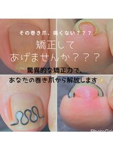 長岡巻き爪矯正センター/巻き爪矯正ビフォーアフター